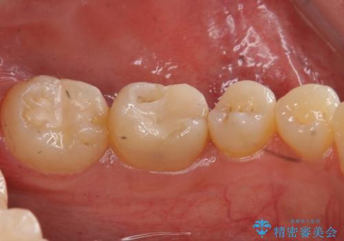 欠けた詰め物 セラミッククラウンでの修復の治療前