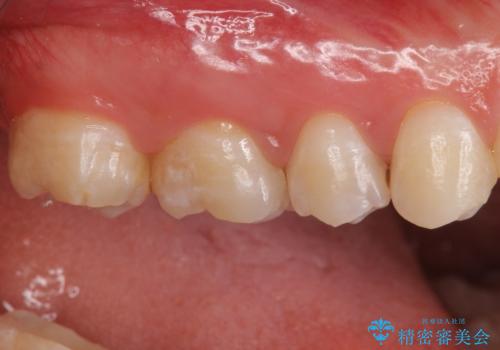 放置した虫歯 セラミックインレーでの治療の治療前