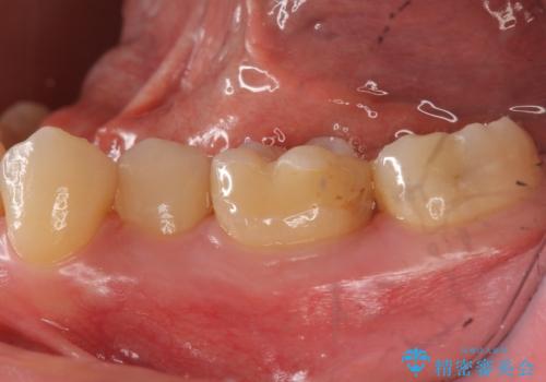 奥歯の詰め物の変色 セラミッククラウンでのやり替えの症例 治療前