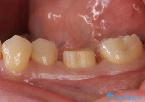 奥歯の詰め物の変色 セラミッククラウンでのやり替えの治療中