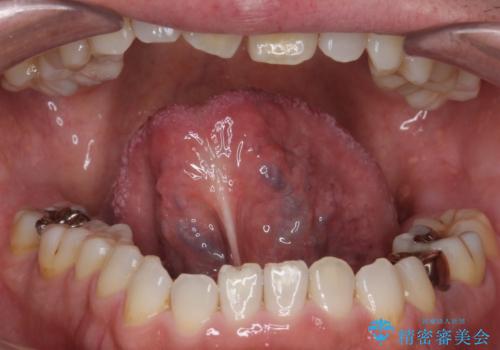 滑舌の悪さを　舌小帯形成術　で改善の治療前