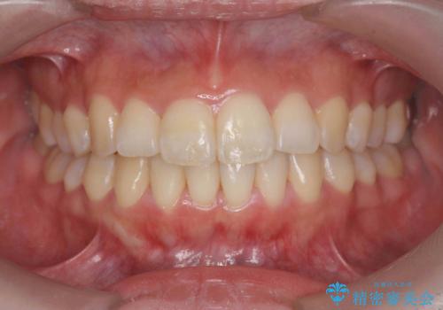 インビザラインで出っ歯の治療の症例 治療後