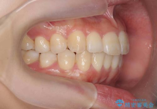 インビザラインで出っ歯の治療の治療後