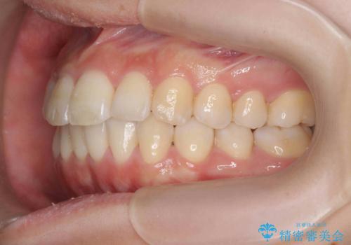 インビザラインで出っ歯の治療の治療後