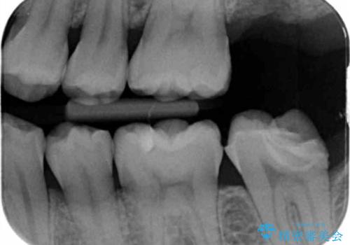 他院で入れたセラミックインレーが取れた。の治療前