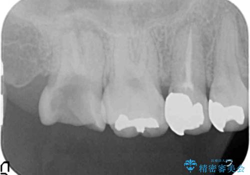 [ 深い虫歯・根管治療・セラミッククラウン ]複合した問題を持った虫歯治療の治療前