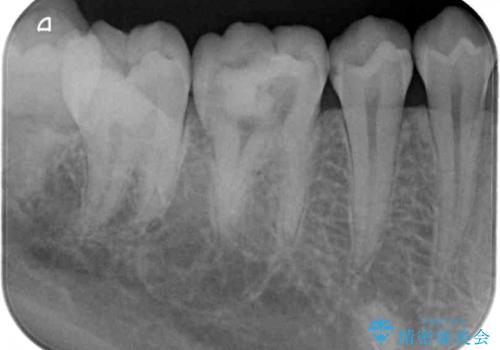 放置した虫歯　根管治療とオールセラミッククラウンの治療前