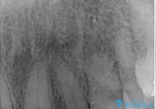 食事の度に痛む 根管治療とオールセラミッククラウンの治療前