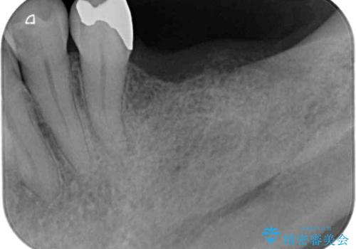 奥歯で噛みたい　インプラントによる欠損補綴治療の治療前