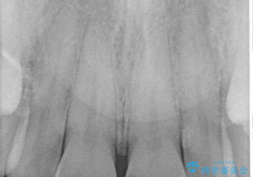 ロードバイク運転中に転倒 欠けてしまった前歯のオールセラミック治療の治療前