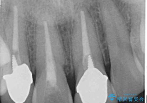 変色した前歯を治したい オールセラミッククラウンによる補綴の治療前