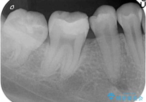 欠けた詰め物 セラミッククラウンでの修復の治療前