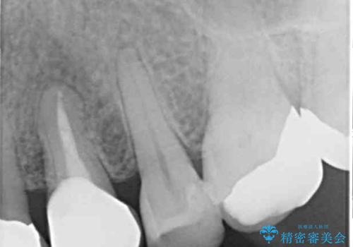 食事の度に痛む 根管治療とオールセラミッククラウンの治療後