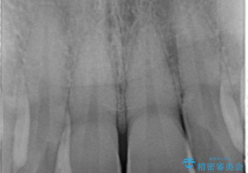 前歯のセラミック治療の治療前