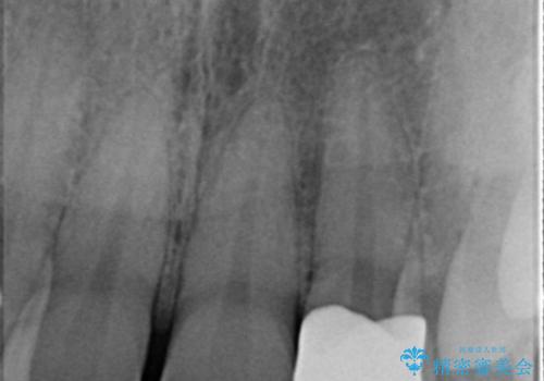 前歯のセラミック治療の治療後