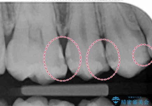 放置した虫歯 セラミックインレーでの治療