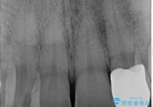 前歯のセラミック治療の治療後