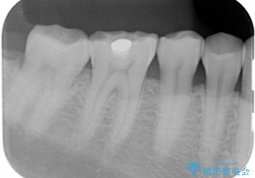 奥歯がしみる。の治療前