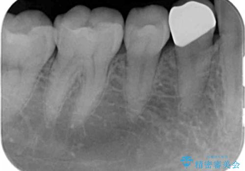 銀の詰め物をオールセラミックで白くしたいの治療後
