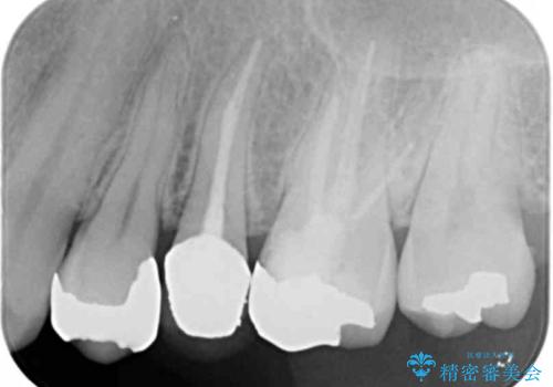 目立つ銀歯を白くしたいの治療前