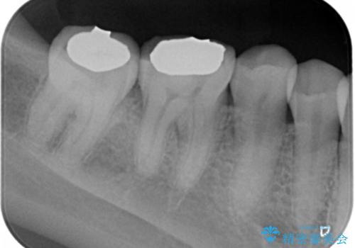 奥歯がしみる。の治療後