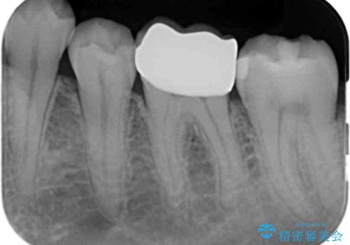 奥歯の詰め物の変色 セラミッククラウンでのやり替えの治療後