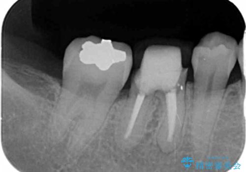 放置した虫歯 ブリッジ治療の治療前