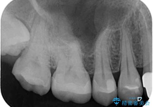 抜歯と言われた奥歯を残したい 奥歯を保存するセラミック治療の治療後