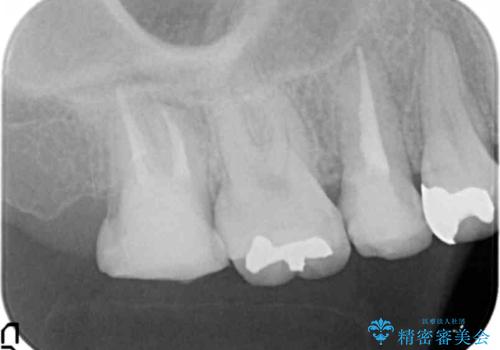 [ 深い虫歯・根管治療・セラミッククラウン ]複合した問題を持った虫歯治療の治療中
