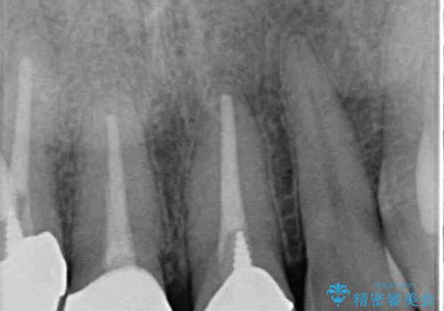 変色した前歯を治したい オールセラミッククラウンによる補綴の治療後