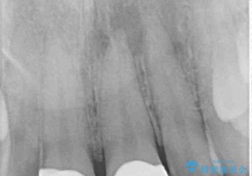 ロードバイク運転中に転倒 欠けてしまった前歯のオールセラミック治療の治療後