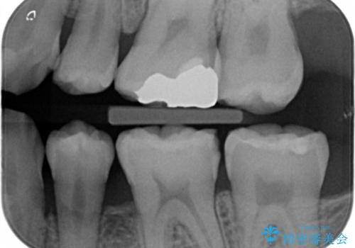 奥歯のザラザラが気になるの治療前
