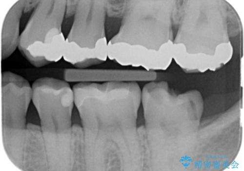 銀の詰め物が取れた。の治療前