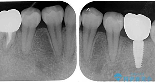 虫歯と抜いたままの奥歯とデコボコの前歯 総合歯科治療の治療後
