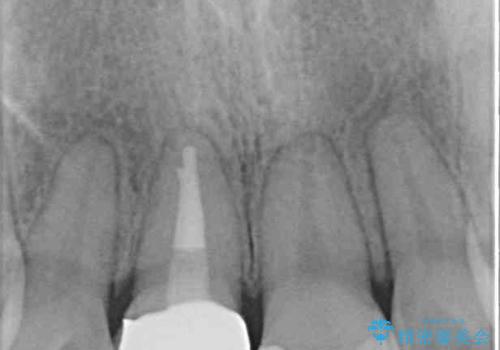 虫歯と抜いたままの奥歯とデコボコの前歯 総合歯科治療の治療後