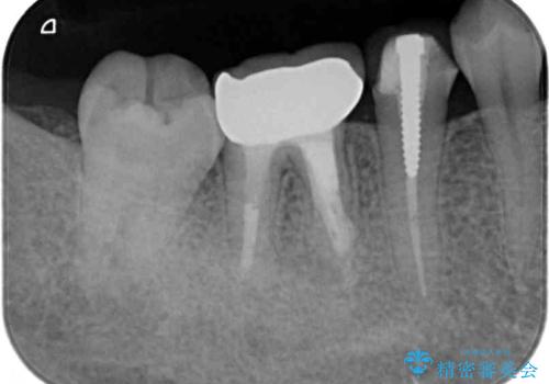 抜歯と言われた奥歯を残したい　奥歯を保存するセラミック治療の治療後
