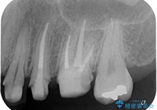 目立つ銀歯を白くしたいの治療中