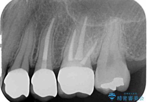 目立つ銀歯を白くしたいの治療後