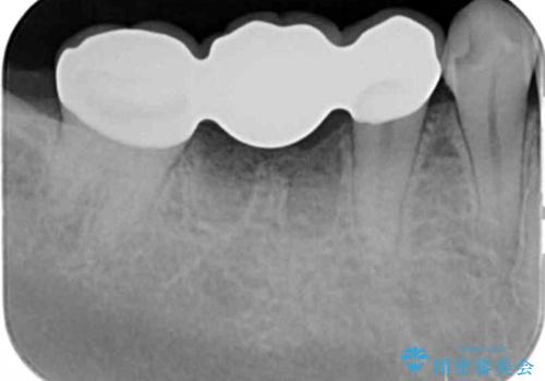 放置した虫歯 ブリッジ治療の治療後