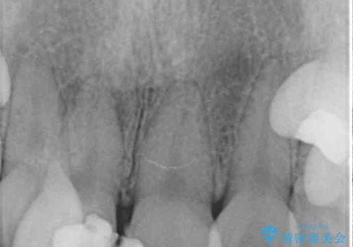 虫歯と抜いたままの奥歯とデコボコの前歯 総合歯科治療の治療前