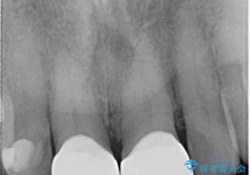 目立つ前歯の変色を改善したいの治療後
