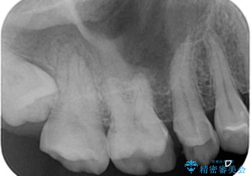 抜歯と言われた奥歯を残したい　奥歯を保存するセラミック治療の治療前