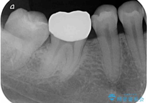 欠けた詰め物 セラミッククラウンでの修復の治療後