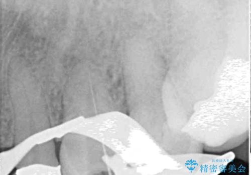 食事の度に痛む 根管治療とオールセラミッククラウンの治療中