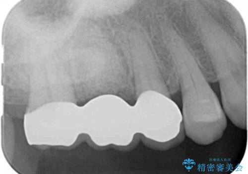 割れた奥歯　適合の良いジルコニアブリッジでの治療の治療後