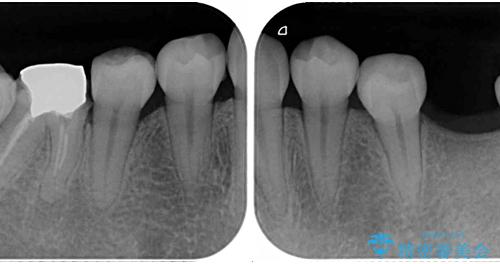 虫歯と抜いたままの奥歯とデコボコの前歯 総合歯科治療の治療前
