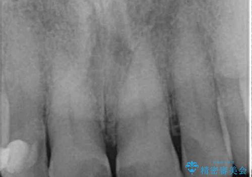 目立つ前歯の変色を改善したいの治療前