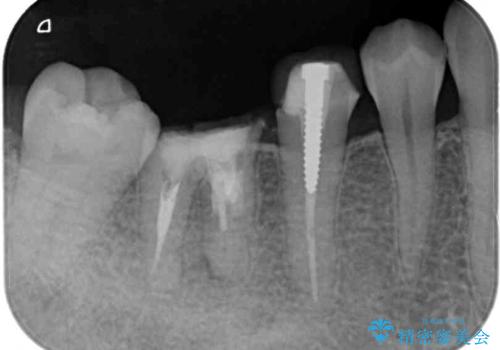 抜歯と言われた奥歯を残したい　奥歯を保存するセラミック治療の治療前
