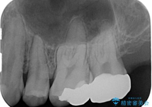 奥歯のザラザラが気になるの治療後
