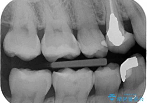 銀の詰め物をオールセラミックで白くしたいの治療前
